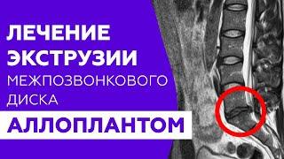 Лечение экструзии межпозвоночного диска позвоночника биоматериалом АЛЛОПЛАНТ