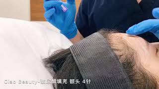 Ciao Beaury-Dr WU dermal filler Forehead