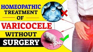 Homeopathic Treatment Of Varicocele Without Surgery | Bharat Homeopathy