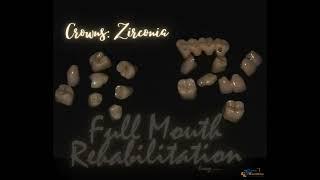 Zirconia Crowns