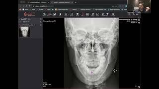 Skull X-Ray Diagnosis by Dr. Imran Lasker  Case 3/10  #ctimaging #xray #radiologyedu