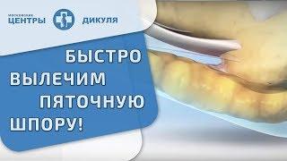  Что такое пяточная шпора и как ее лечить. Пяточная шпора как лечить. Дикуль. 12+