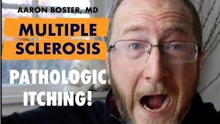 Multiple Sclerosis Rare Symptom: pathologic Itching with MS