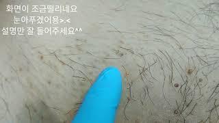 waxing #왁싱 받고 피부가 이상해요, #브라질리언왁싱 후 피부관리방법, 왁싱후 생기는 피부염증 방치하지마세요