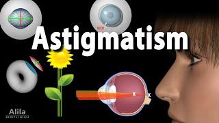 Astigmatism: Types, Causes, Symptoms and Treatment Options, Animation