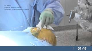 PMT sEEG Implant Procedure