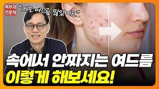 피부속 짤수 없는 여드름, 어떻게 해야되나요⁉ | 여드름 없애는법, 여드름치료