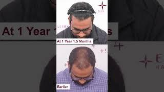 Best Hair Transplant clinic in Hyderabad | Hair Transplant Results in Hyderabad #besthairtransplant