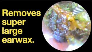 Removes super large earwax. |ear wax removal | ear cleaning | ASMR | relaxation | relax