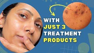 Only Skincare Products You Need to FADE DARK SPOTS on Face | dry, oily, combination & normal skin