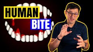 Human Bite Treatment