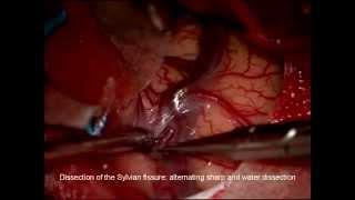 Middle cerebral artery bifurcation and M1 aneurysm clip reconstruction