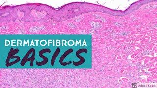 Dermatofibroma 101 (Benign Fibrous Histiocytoma)...Explained by a Dermatopathologist