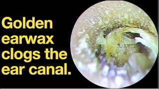 Golden earwax clogs the ear canal. |ear wax removal | ear cleaning | ASMR | relaxation | relax