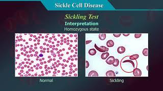 Sickle Cell Disease