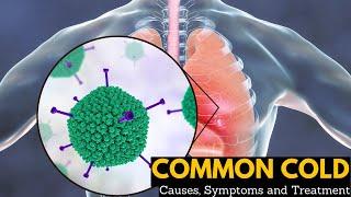 Common Cold, Causes, Signs and Symptoms, Diagnosis and Treatment.