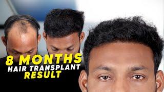 Hair Transplant in Chitradurga | Best Results & Cost of Hair Transplant in Chitradurga