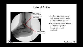 Ankle fractures - 1 of 4 - OTA CCv5