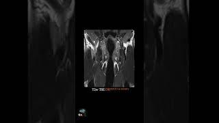 MRI – LARYNX @3T