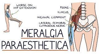 Understanding Meralgia Paraesthetica