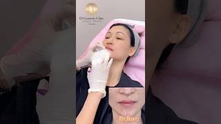 嘴唇填充多伦多Lip Filler Toronto #你尝试过医美吗 #变美 #玻尿酸 #加拿大