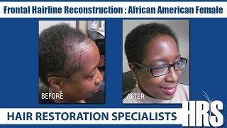 African American Hair Transplant at Hair Restoration Specialists of Atlanta