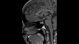 How to read an MRI of the pituitary gland | First Look MRI