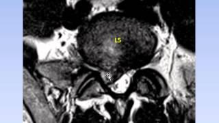 Dr. Gillard Lectures on Lumbar Disc Herniation / Protrusion. Part II of II.