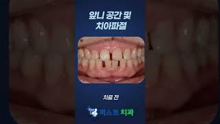 앞니 벌어짐 가장 좋은 치료방법은? #shorts
