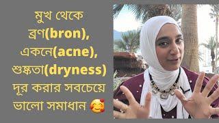 মুখ থেকে ব্রণ(bron), একনে(acne), শুষ্কতা(dryness) দূর করার সবচেয়ে ভালো সমাধান 