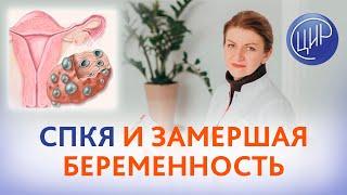 СПКЯ, замершая беременность и повышен гематокрит. Что делать? Акушер-гинеколог ЦИР Дементьева С.Н.