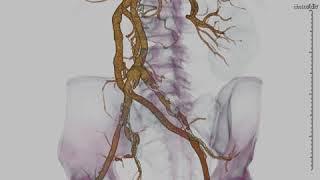 mid aortic syndrome