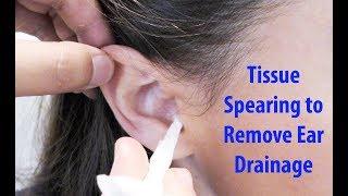 Tissue Spears to Remove Ear Drainage