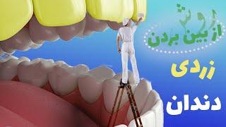 دوازده روش از بین بردن زردی دندان ها