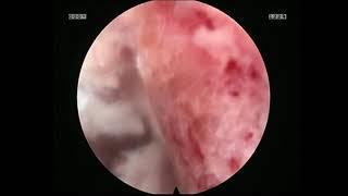 Endoscopic Disc Space Preparation for Fusion