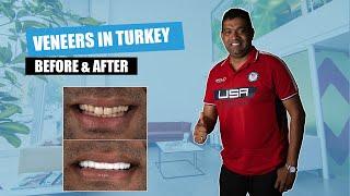 Veneers in Turkey  Before & After 2021 | Myra Dental Centre in Turkey