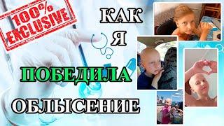 Облысение. Облысение у детей причины. Как вылечить облысение