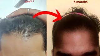 THE MOST INSANE HAIR GROWTH IVE EVER SEEN FROM MINOXIDIL!!