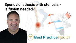 Is fusion necessary for the treatment of spondylolisthesis with stenosis? | Best Practice LIVE