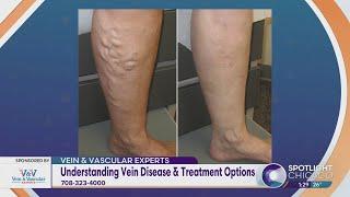 Understanding Vein Disease & Treatment Options