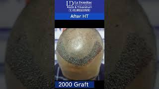 Hairline correction | 2000 Grafts | Advanced FUE |6 Months result @ La  Densitae -kochi