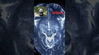 Wilson Disease