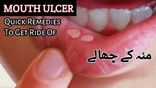 Mouth Ulcer Home Remedy/ Oral Ulcer Treatment/ Muh K Chalon ka ilaj/ MOUTH ULCER