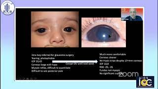 APSPOS Session - Dr. Arif O Khan- A Glaucoma diagnosis that is important not to miss