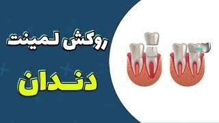 روکش لمینت دندان 