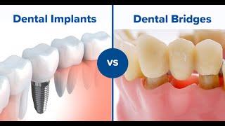 Which is better a dental bridge or implant?