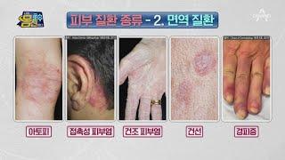 당뇨와 고혈압처럼 평생 관리해야한다?! 면역 균형이 깨지며 생기는 피부질환들 | 나는 몸신이다 359 회