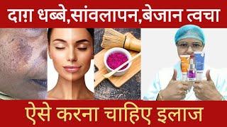 दाग़ धब्बे, सांवलापन या TANNING, कैसे ठीक करें, क्या है सही तरीका? #trending #skin #tanning