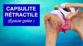 CAPSULITE RÉTRACTILE (Épaule gelée) : Explications, Causes et Traitements