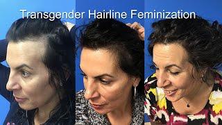 Transgender Hairline Feminization